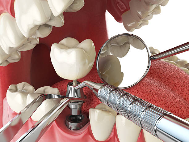 Best Emergency Broken Tooth Repair in Penngrove, CA